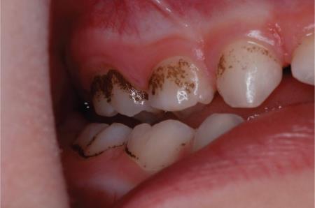 تاثیر قطره آهن بر دندان ها