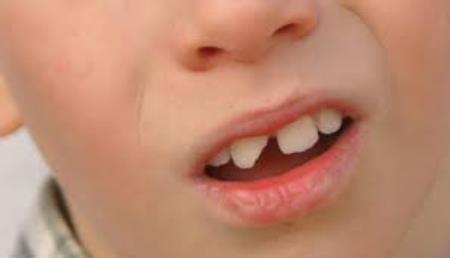 شکستگی دندان کودکان یا تروما دندان