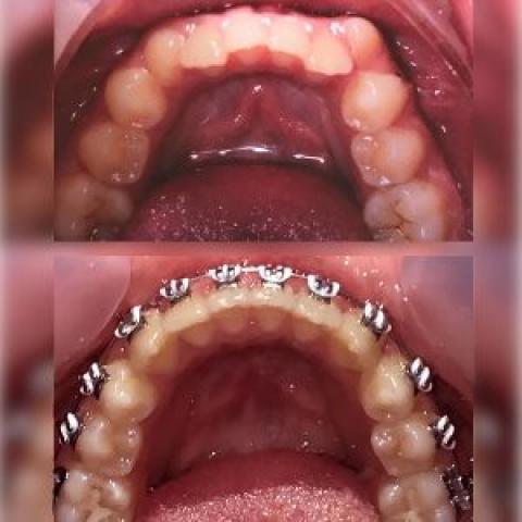  درمان ارتودنسی بدون کشیدن دندانهای دائمی