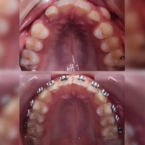  درمان ارتودنسی بدون کشیدن دندانهای دائمی